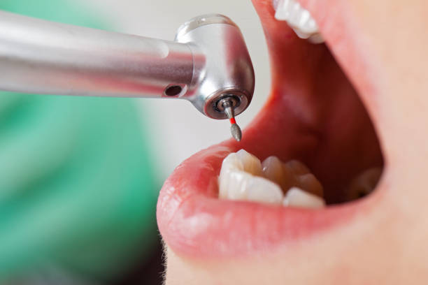 Best Emergency Cosmetic Dentistry (e.g., broken veneers) in North Potomac, MD